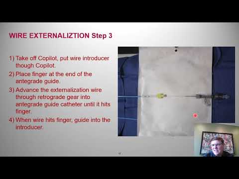 Guidewire externalization: Step-by-step - Tony Doing, MD