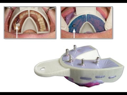 Miratray Implant lenyomatkanál rendszer