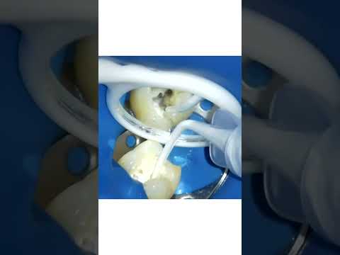 Obturation au dia root partie 3 – Endodontie