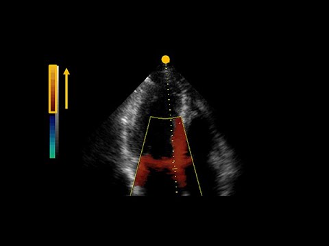 What is tissue Doppler and speckle tracking in echocardiography