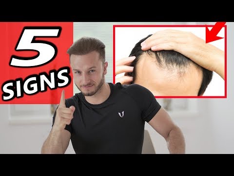 5 Early Signs of Balding + 3 Tips to prevent it NOW!