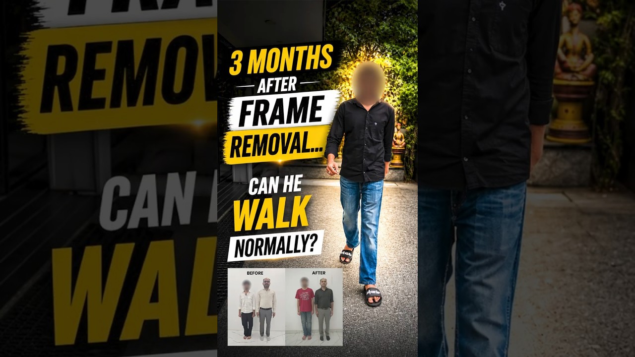3 Months After Frame Removal | Can He Walk Normally? | Height increasing surgery in India