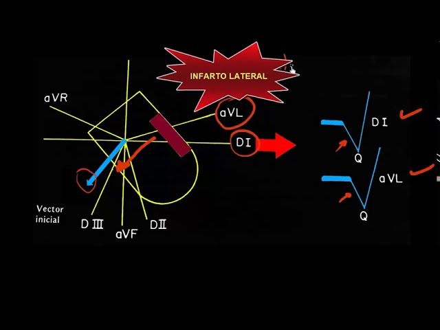 Videouttalande av cardiopathy Engelska