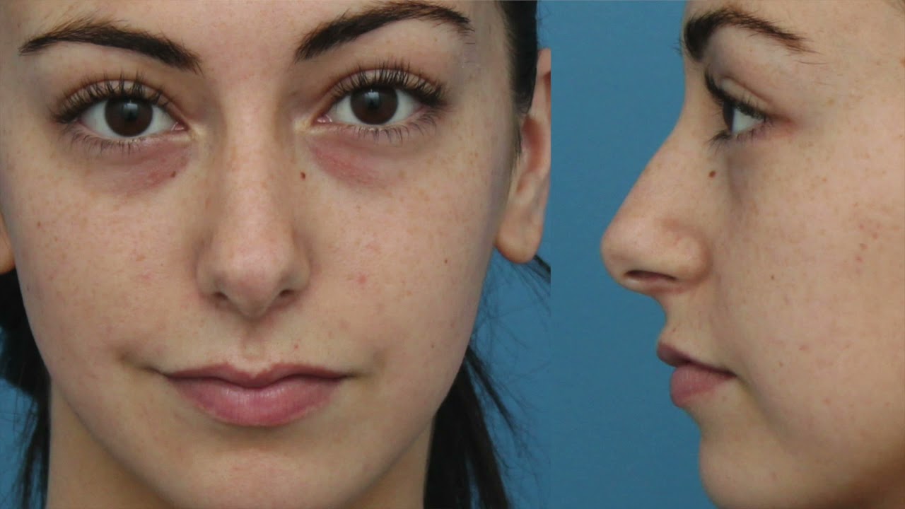 Rhinoplasty Reveal - #10