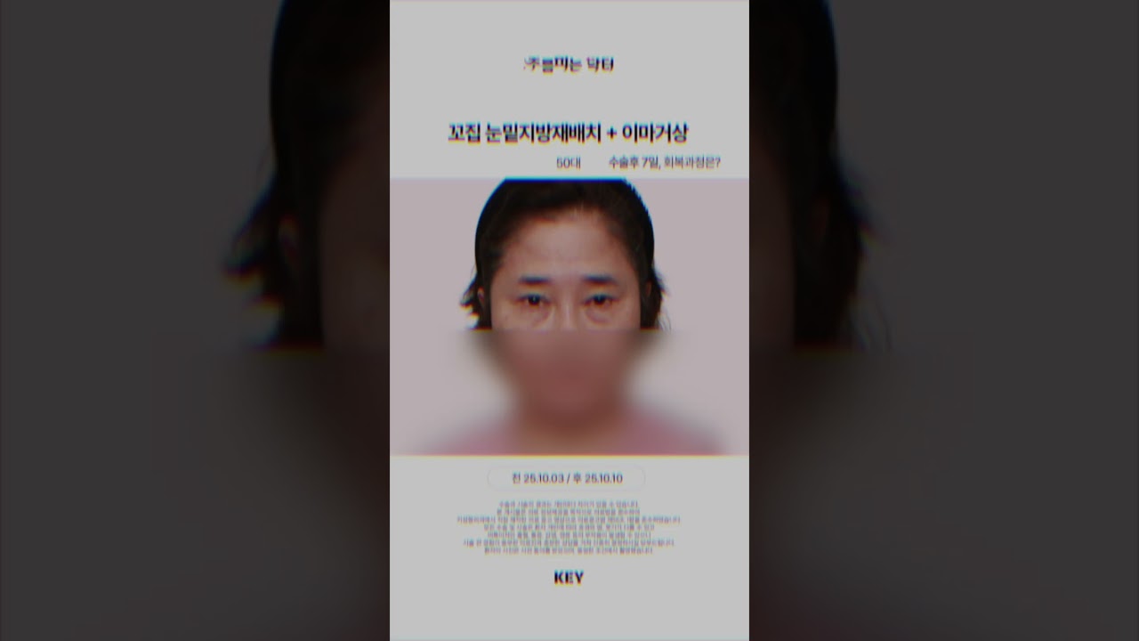 50대 꼬집 눈밑지방재배치 + 이마거상