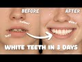 How I Got WHITE TEETH In Just 3 Days Beauty With Brain