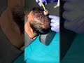 Derma Roller After PRP For Hair Loss Treatment PRP Therapy Skinaa Clinic Shorts Viral Short