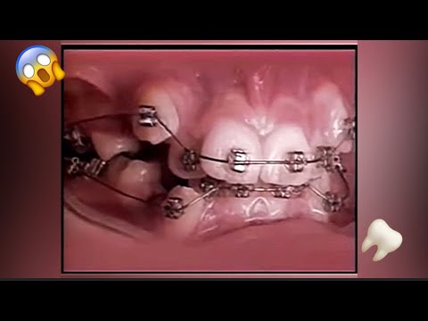 2 Years Of Braces In 20 Seconds!- Braces Timelapse 