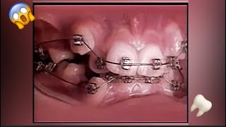 2 Years Of Braces In 20 Seconds!- Braces Timelapse #Shorts