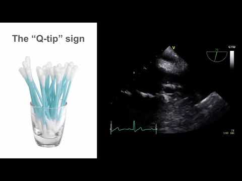 TEE Essentials: Mastering the mid-esophageal left atrial appendage view