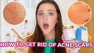 How I Cleared My Acne Scars for GOOD | Do Acne Scars Go Away? Truly Beauty