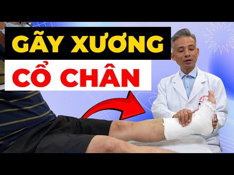 Gãy Xương Cổ Chân - Nỗi Ám Ảnh Không Thể Đi Lại & Cách Hồi Phục Nhanh Nhất
