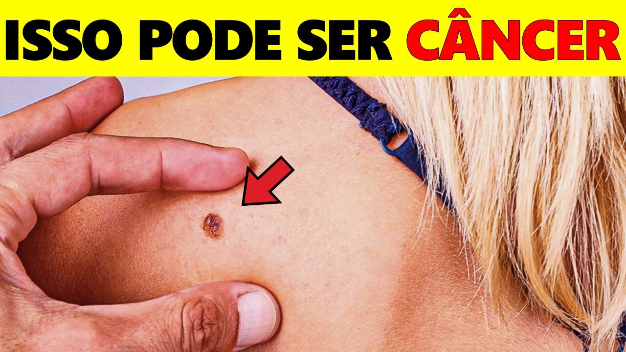 Alerta! 14 SINAIS de que Você Pode TER CÂNCER e NIGNUÉM TE CONTA