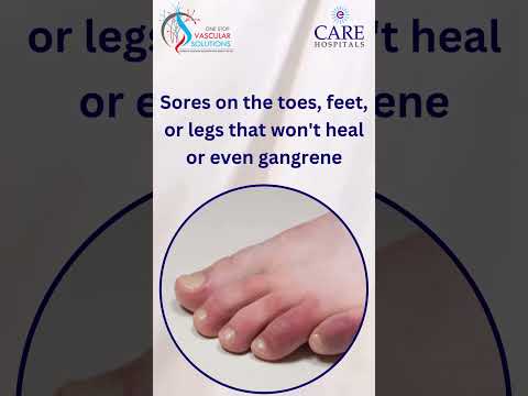 PAD Symptoms | One stop vascular solutions | Dr. RAHUL AGARWAL | Dr. P.C GUPTA