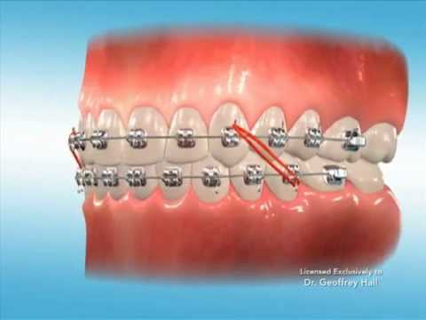download lagu mp3 mp4 Clear Elastics Braces, download lagu Clear Elastics Braces gratis, unduh video klip Clear Elastics Braces