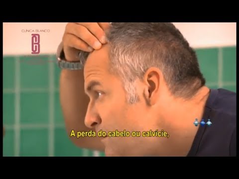 Dr. Alexandre Nunes - Cirurgia Capilar