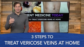 3 Steps to Treat Varicose Veins at Home
