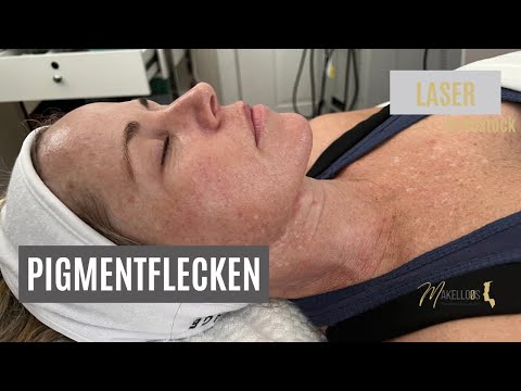 Pigmentflecken & Altersflecken mit Laser entfernen - D.A.L.M. Dr. Teichert Makelloos Rostock