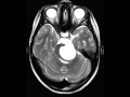 Pilocytc Astrocytoma