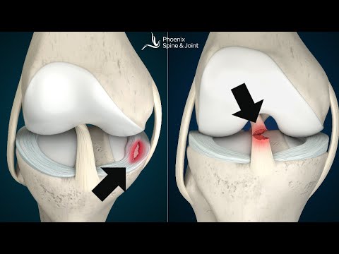 Is your knee pain coming from an ACL tear or Meniscus injury? How to tell.