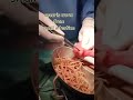 Ascaris Worm From Small Intestine Tarang Academy
