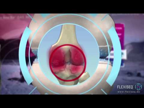 Medikamente Hals Chondrose zur Behandlung von Über die wichtigste Behandlung von Osteoarthritis