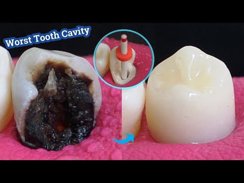 Miraculous Restoration Of Decayed And Broken Tooth! Severe Tooth Caries.