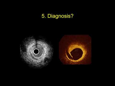 Essentials of IVUS and OCT