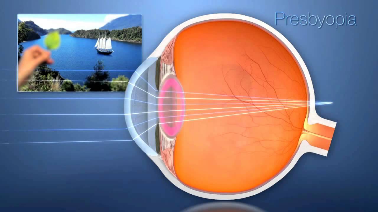 Understanding Presbyopia