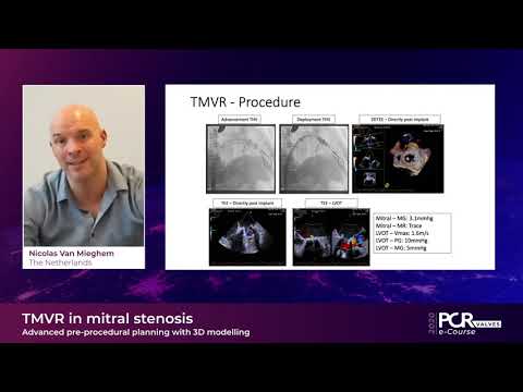 TMVR in Mitral Stenosis – Advanced pre-procedural planning aided by 3D - PCR Valves e-Course 2020