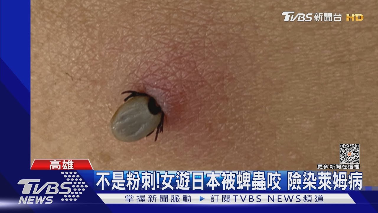 這真的不是粉刺!遊日本小心 女被蜱蟲咬險染萊姆病