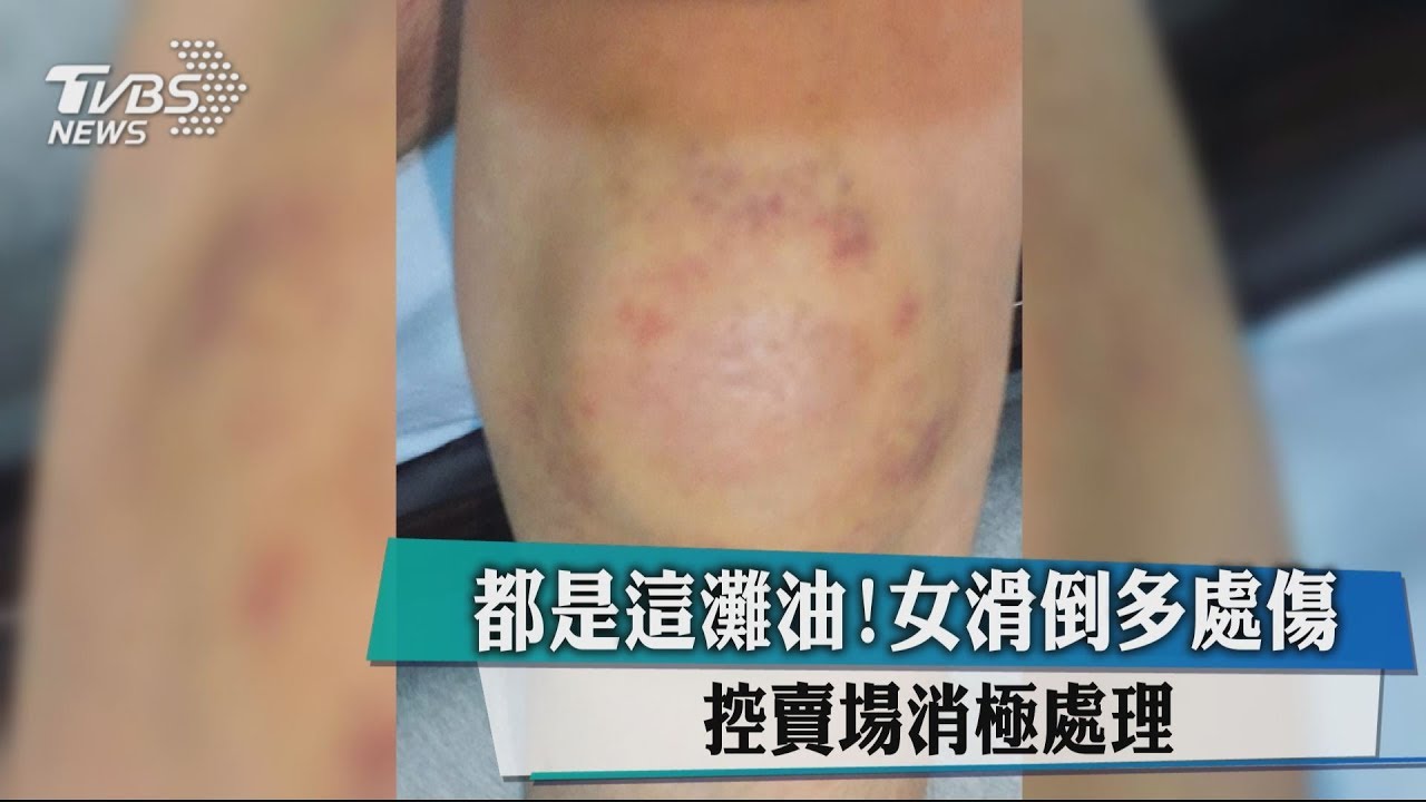都是這灘油!女滑倒多處傷 控賣場消極處理