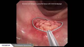Endoscopic Mycosal Resection (EMR) procedure overview of a sessile polyp using Olympus devices