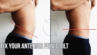 How To Fix Anterior Pelvic Tilt (APT)