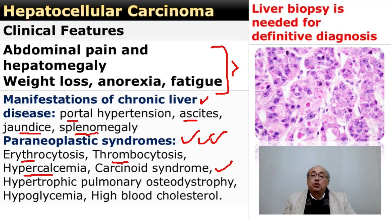 Hepatoma (Hepatocellular carcinoma)