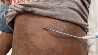 How can Suturing Without Needle Holder Complete Procedure in Hindi/Urdu