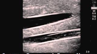 Product video: CAE Blue Phantom Central Line Ultrasound Training Models