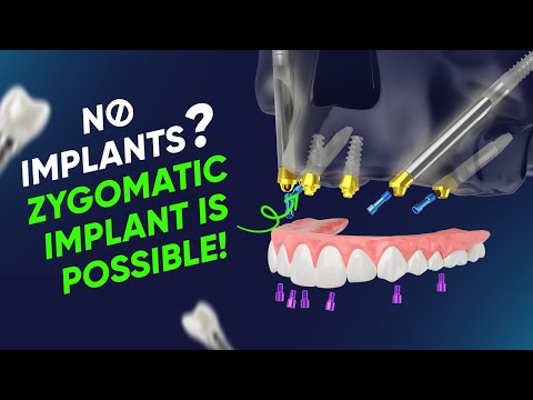 Zygomatic Implants Explained | Fixed Teeth for Severe Bone Loss