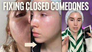 CLOSED COMEDONES | How I cleared my clogged pores, routine and products
