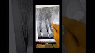 No cbct. #dentists #dentalcare #rootcanaltherapy #foreigntraineddentist #dentalprosthesis