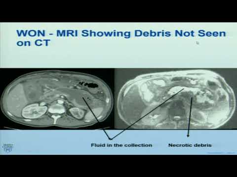 Medicine Grand Rounds: Acute Pancreatitis 3/5/19