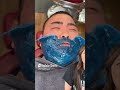 He Really Took It Like A CHAMP DrPimplePopper