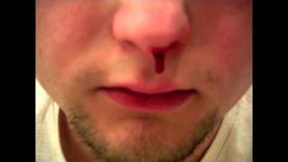 Fact: Rebecca Blacks Awesomness Causes Nose Bleeds