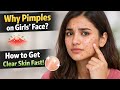 Girls Face Acne Why Pimples Happen How To Cure Them