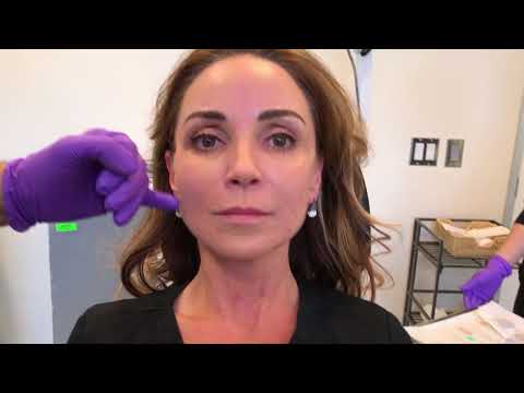 download lagu mp3 mp4 Thread Lift Recovery Time, download lagu Thread Lift Recovery Time gratis, unduh video klip Thread Lift Recovery Time