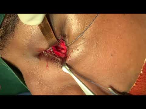 Treatment Of Orbital Floor Fracture