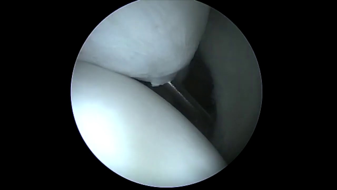 Dr. Garcia demonstrates his technique for SLAP repair