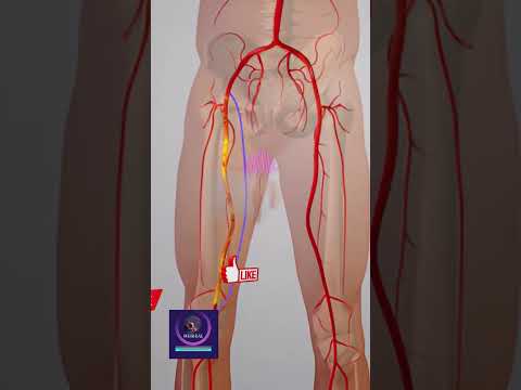 Peripheral Artery Bypass Surgery