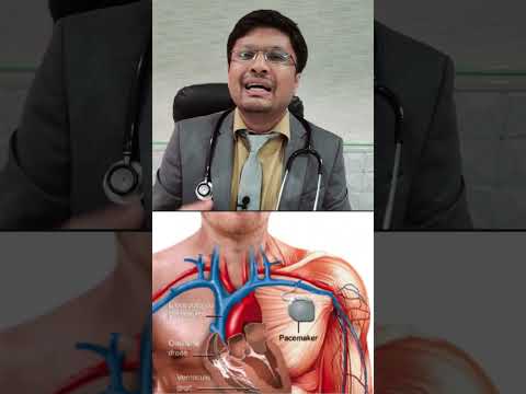 #What is a pacemaker? When is it necessary to put it in? "Pacemaker: Everything You Need to Know"