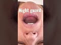 Night Guard ,for Bruxism: Teeth Grinding and Clenching